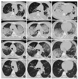 鹦鹉热患者肺部