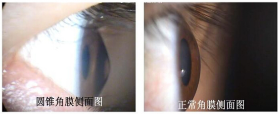 健康角膜与病变角膜对比 健康角膜与病变角膜对比