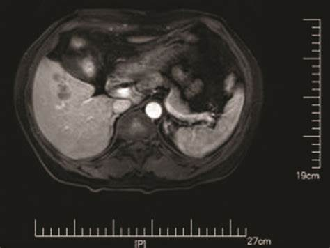 肝吸虫在胆管内的寄生状态显微照片 肝吸虫在胆管内的寄生状态显微照片