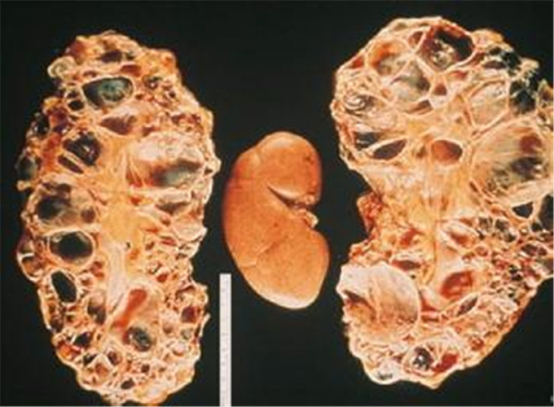 中毒患者肾脏病理切片对比图 中毒患者肾脏病理切片对比图