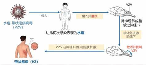 带状疱疹的“三重打击”：生理、心理与社会负担