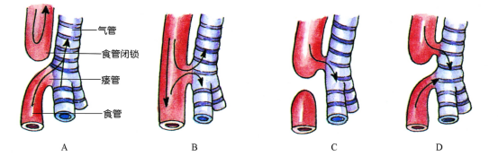 什么是支气管食管瘘 什么是支气管食管瘘