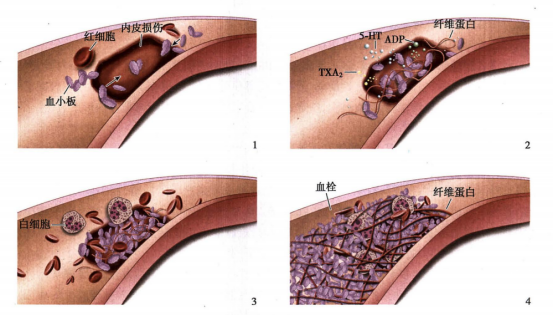 解密微血栓:大脑的隐形杀手 解密微血栓:大脑的隐形杀手