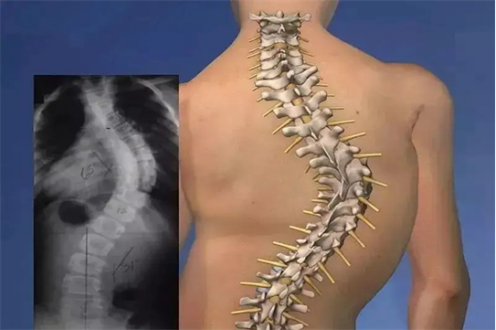 脊柱侧弯:被忽视的“隐形 epidemic” 脊柱侧弯:被忽视的“隐形 epidemic”