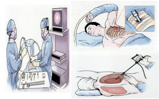 技术突破:改良胸腔镜的四大核心升级 技术突破:改良胸腔镜的四大核心升级