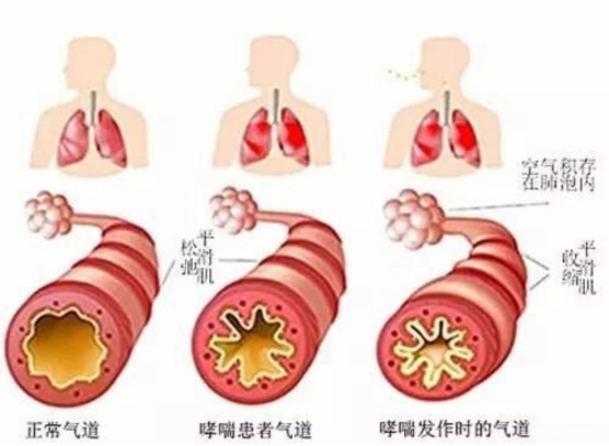 儿童支气管哮喘的疾病特征与治疗挑战 儿童支气管哮喘的疾病特征与治疗挑战