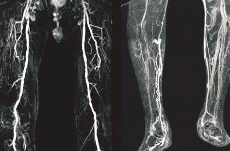 Fournier坏疽：被低估的男性健康杀手