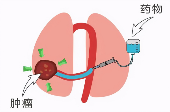 疾病探源：揭开LYG的神秘面纱