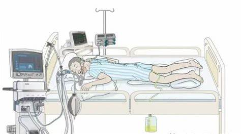 ECMO与俯卧位通气技术概述 ECMO与俯卧位通气技术概述