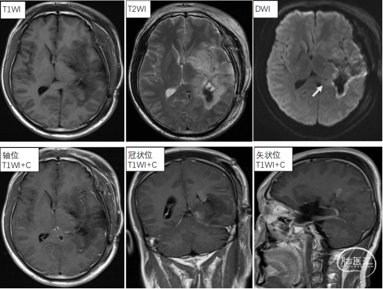 胶质母细胞瘤:难以攻克的医学难题 胶质母细胞瘤:难以攻克的医学难题