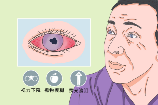 隐匿性后葡萄膜炎误诊的原因分析 隐匿性后葡萄膜炎误诊的原因分析