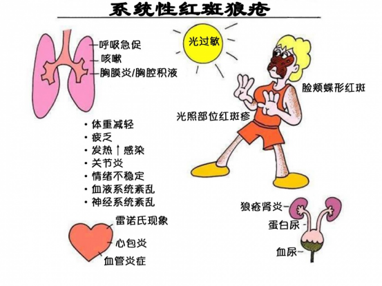 系统性红斑狼疮患者的自我管理与生活调整 系统性红斑狼疮患者的自我管理与生活调整