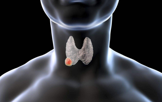 甲状腺结节的基本概念与现状 甲状腺结节的基本概念与现状