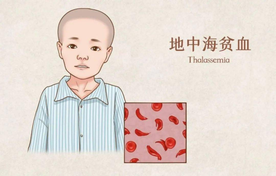 β-地中海贫血患者的生存困境 β-地中海贫血患者的生存困境