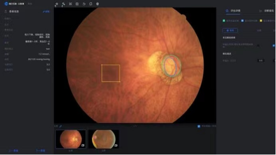 AI辅助诊断青光眼的技术原理与优势 AI辅助诊断青光眼的技术原理与优势