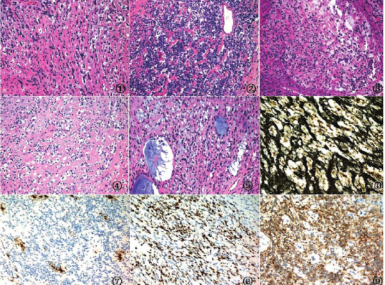 临床证据:从髓母细胞瘤到多癌种突破 临床证据:从髓母细胞瘤到多癌种突破