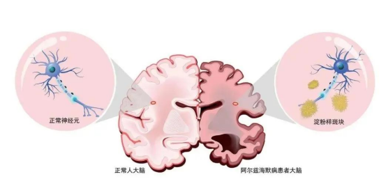 年轻血浆治疗阿尔茨海默病面临的挑战与争议 年轻血浆治疗阿尔茨海默病面临的挑战与争议