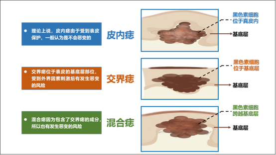黑色素瘤治疗的革命性突破 黑色素瘤治疗的革命性突破