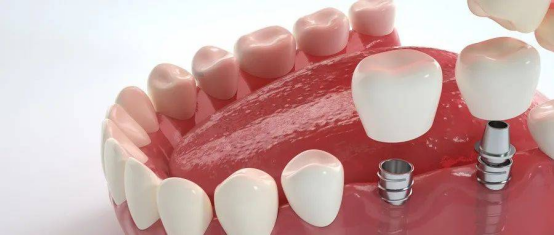 种植牙“天价”之困