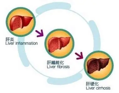 临床奇迹：从胆红素554到完全康复的108天