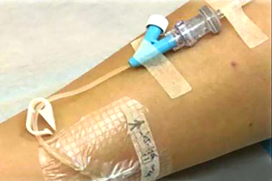 肿瘤患者如何正确选择静脉输液通路? - 家庭医生 - 新湖南 肿瘤患者如何正确选择静脉输液通路? - 家庭医生 - 新湖南